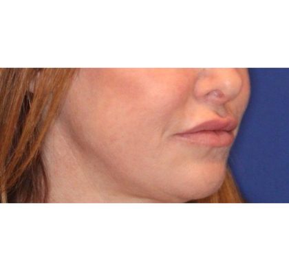 Lip Filler Before & After Patient #13827