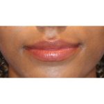 Lip Filler Before & After Patient #13823