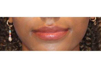 Lip Filler Before & After Patient #13823