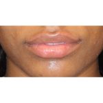Lip Filler Before & After Patient #13823