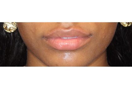 Lip Filler Before & After Patient #13823