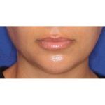 Lip Filler Before & After Patient #13837