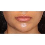 Lip Filler Before & After Patient #13837