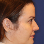 Emface Before & After Patient #16194