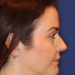 Emface Before & After Patient #16194