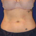 Emsculpt NEO Before & After Patient #16195