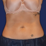 Emsculpt NEO Before & After Patient #16195