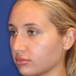 JL Facial Balancing Before & After Patient #16196