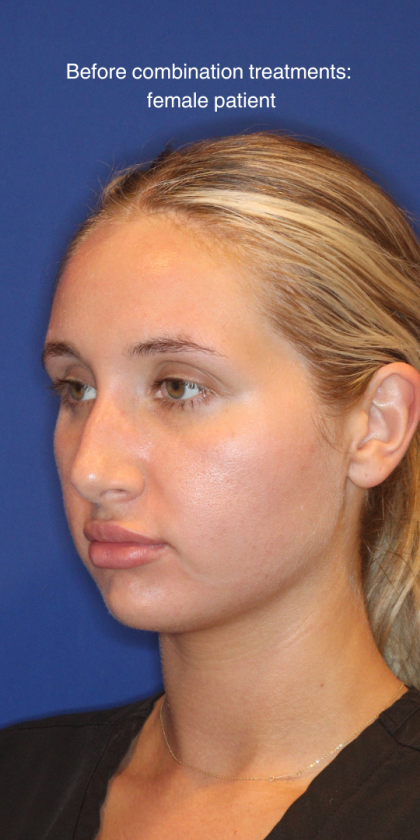 JL Facial Balancing Before & After Patient #16196