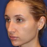 JL Facial Balancing Before & After Patient #16196