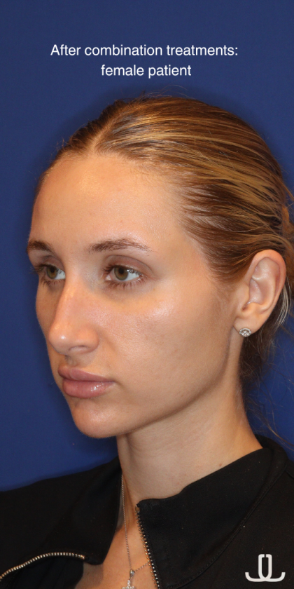 JL Facial Balancing Before & After Patient #16196