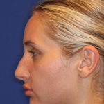 JL Facial Balancing Before & After Patient #16196
