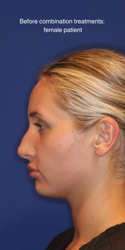 JL Facial Balancing Before & After Patient #16196