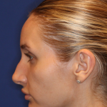 JL Facial Balancing Before & After Patient #16196