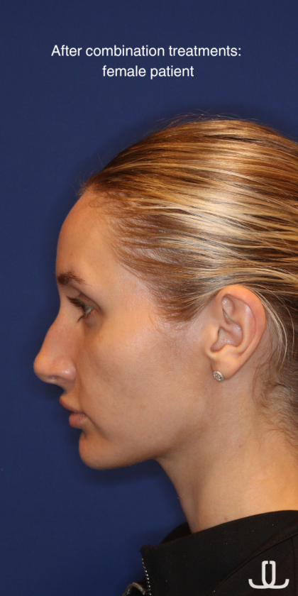 JL Facial Balancing Before & After Patient #16196