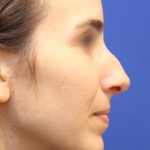 Rhinoplasty Before & After Patient #16199