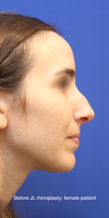 Rhinoplasty Before & After Patient #16199