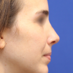 Rhinoplasty Before & After Patient #16199