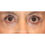 SylfirmX Before & After Patient #16200