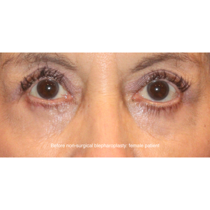 SylfirmX Before & After Patient #16200