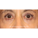 SylfirmX Before & After Patient #16200