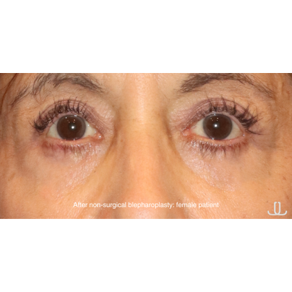 SylfirmX Before & After Patient #16200