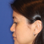 Non-Surgical Nose Job Before & After Patient #16197