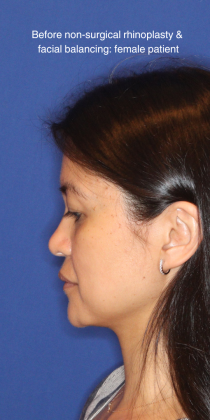 JL Facial Balancing Before & After Patient #16198