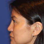 Non-Surgical Nose Job Before & After Patient #16197