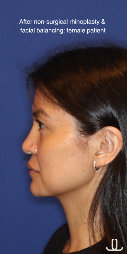 JL Facial Balancing Before & After Patient #16198