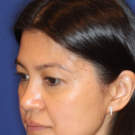Non-Surgical Nose Job Before & After Patient #16197