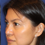 Non-Surgical Nose Job Before & After Patient #16197