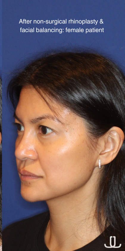 JL Facial Balancing Before & After Patient #16198