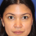 Non-Surgical Nose Job Before & After Patient #16197