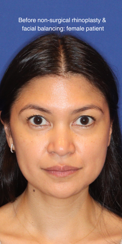 JL Facial Balancing Before & After Patient #16198