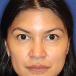 Non-Surgical Nose Job Before & After Patient #16197