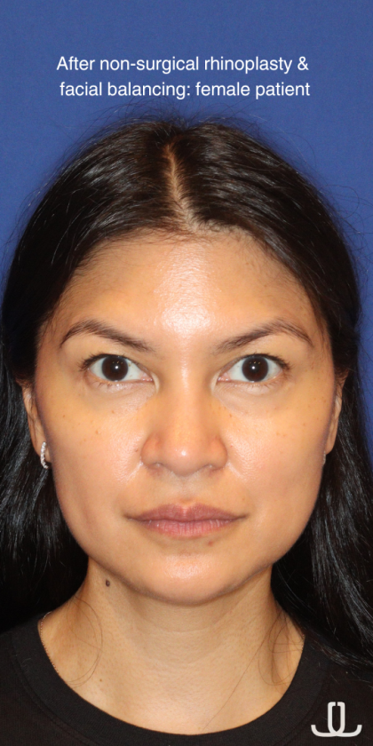 JL Facial Balancing Before & After Patient #16198
