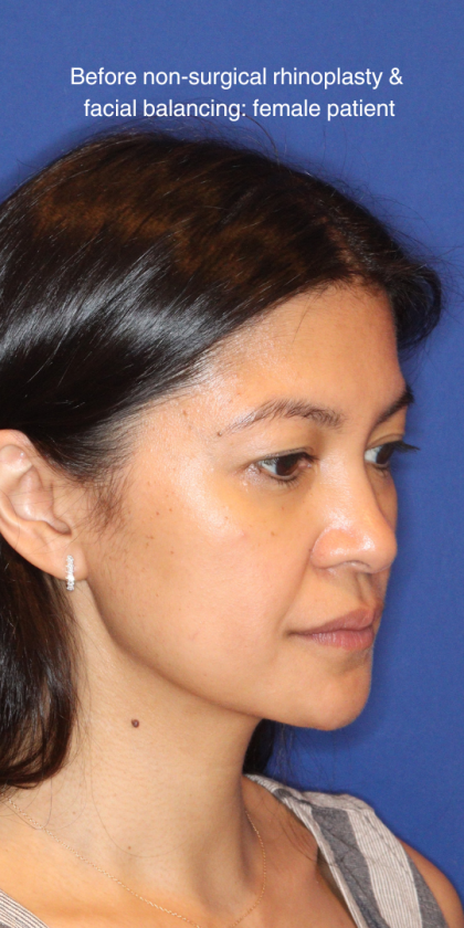 JL Facial Balancing Before & After Patient #16198