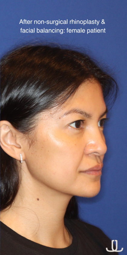 JL Facial Balancing Before & After Patient #16198