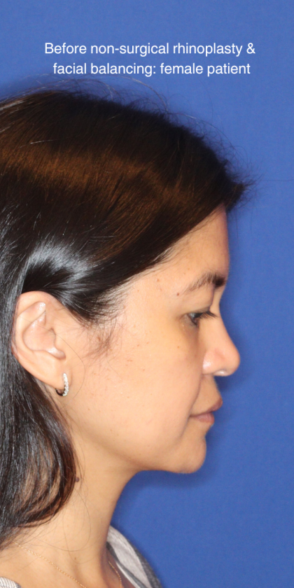 JL Facial Balancing Before & After Patient #16198