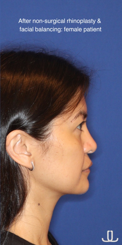 JL Facial Balancing Before & After Patient #16198