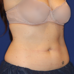Emsculpt NEO Before & After Patient #16195