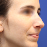 Rhinoplasty Before & After Patient #16199