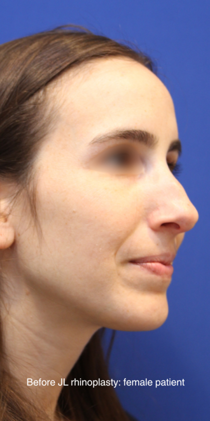 Rhinoplasty Before & After Patient #16199