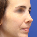 Rhinoplasty Before & After Patient #16199