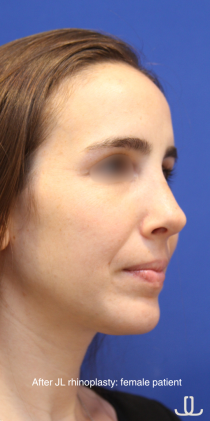 Rhinoplasty Before & After Patient #16199