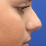 Teen Rhinoplasty Before & After Patient #16446