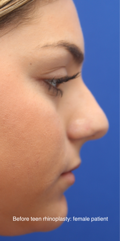 Teen Rhinoplasty Before & After Patient #16446