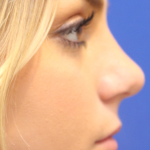 Teen Rhinoplasty Before & After Patient #16446
