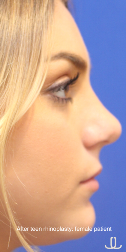 Teen Rhinoplasty Before & After Patient #16446